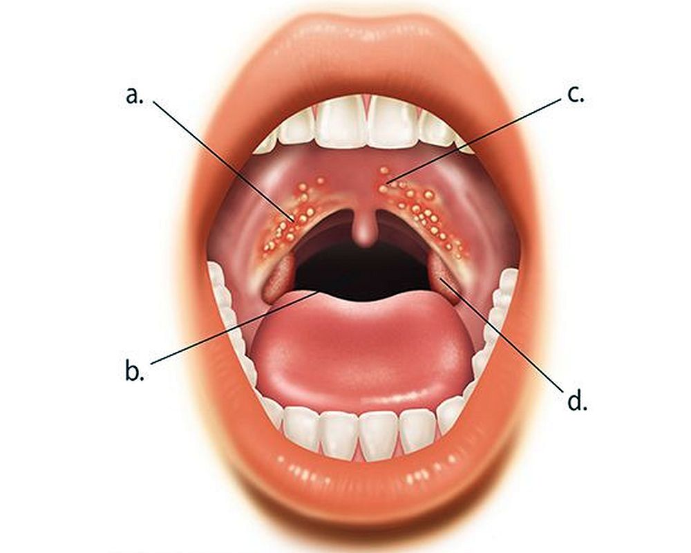 Herpangina: conoce sus causas y síntomas